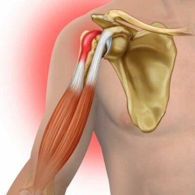 Biceps Tenodesis | Biceps Tendon Repair