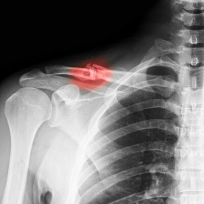 Clavicle Fracture | Broken Collar Bone