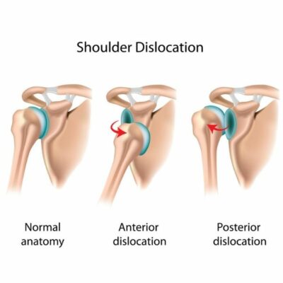 Dislocated Shoulder | Shoulder Instability