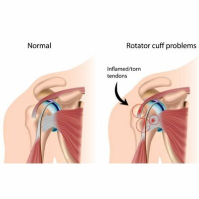 Rotator Cuff Tear | Rotator Cuff Tendonitis