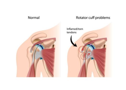 https://shoulderclinicofidaho.com/wp-content/uploads/2018/09/Rotator-Cuff-Injury-FI-Size.jpg