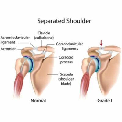 Acromioclavicular (AC) Joint Injury | Separated Shoulder