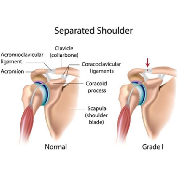 AC Joint Injuries | Shoulder Specialist Boise, Meridian, Nampa, Valley