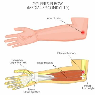 Medial Elbow Epicondylitis Repair | Golfer's Elbow