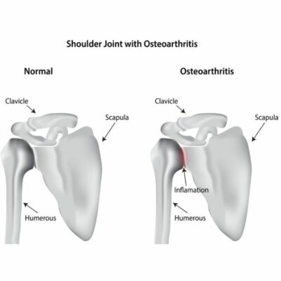 Shoulder Osteoarthritis | Joint Preservation | Cartilage Restoration