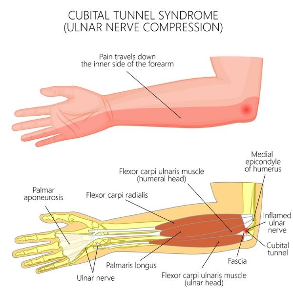 What is ulnar nerve surgery?