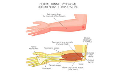 Ulnar Nerve Entrapment and Cubital Tunnel Syndrome